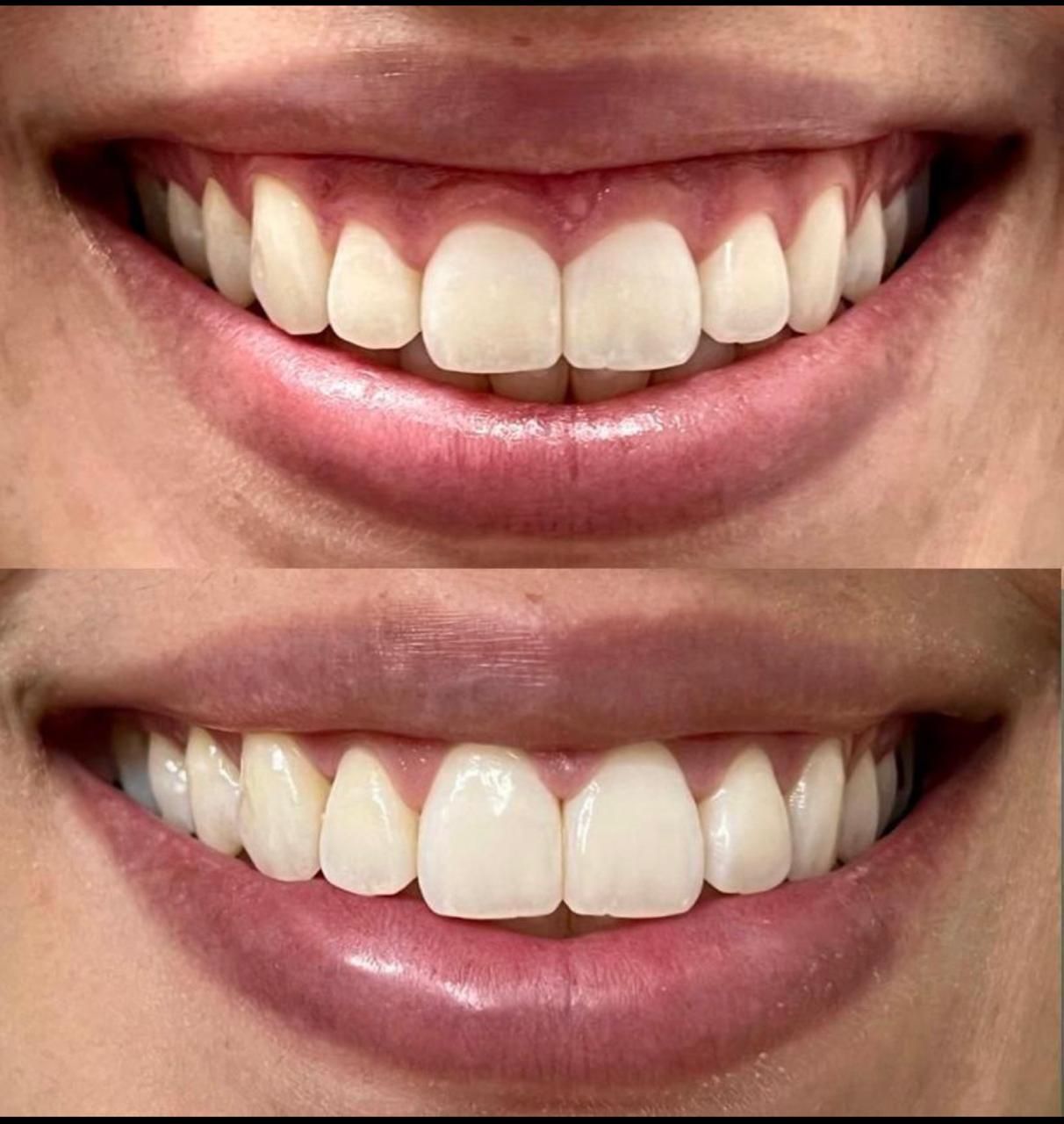 Caso tratado na Clínica Vaccari: acima, o sorriso no diagnóstico; abaixo, após o tratamento.
